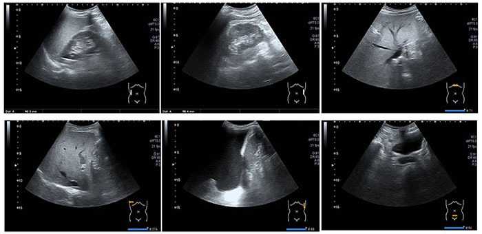 Abdomial Ultrasound Bozeman MT Abdomial Ultrasound Bozeman MT