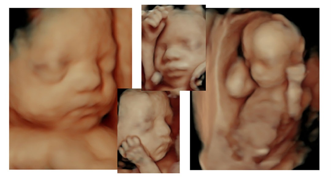 Baby ultrasound Images Baby ultrasound Images