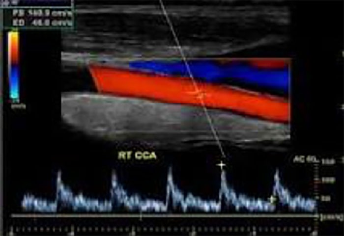 Carotid Ultrasound Bozeman MT Carotid Ultrasound Bozeman MT
