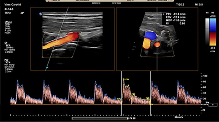 Vascular Ultrasound Bozeman MT Vascular Ultrasound Bozeman MT