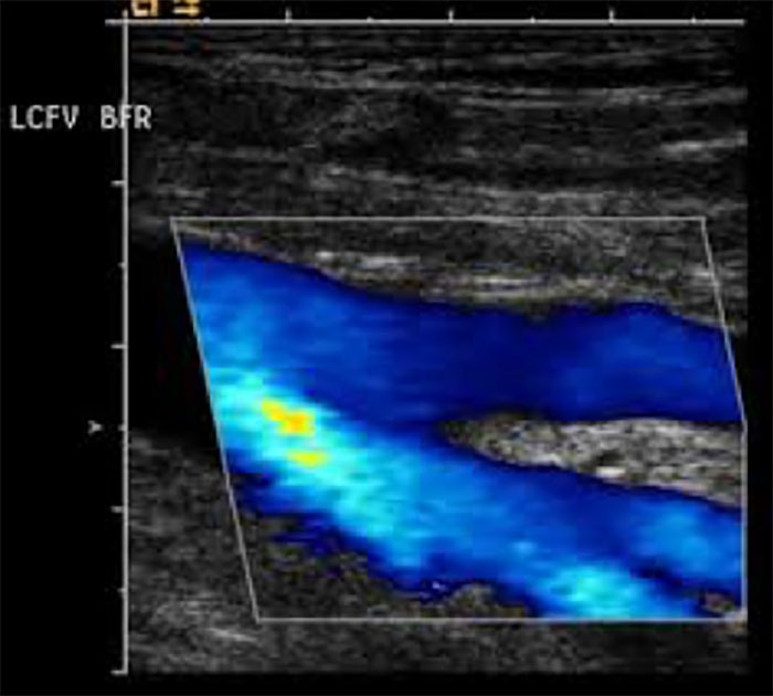 Venous Ultrasound Bozeman MT Venous Ultrasound Bozeman MT